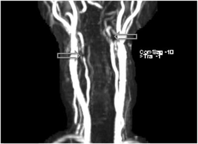 Lenvatinib-Associated Cervical Artery Dissections in a Patient with Radioiodine-Refractory Metastatic Papillary Thyroid Carcinoma